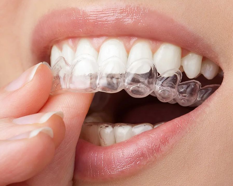 Dental Aligners